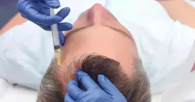 PRP FOR HAIR LOSS